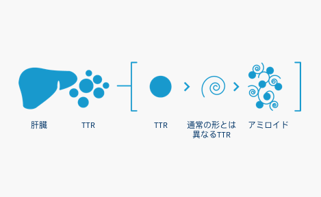 トランスサイレチン型家族性アミロイドポリニューロパチー
